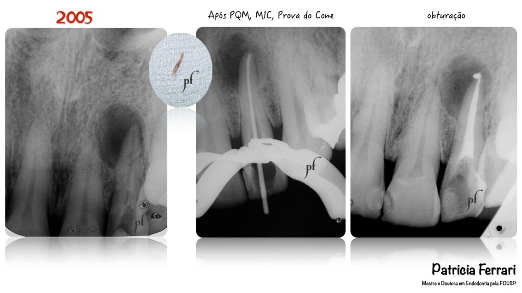 Insucesso E Retratamento Endod Ntico Patricia Ferrari Endodontia