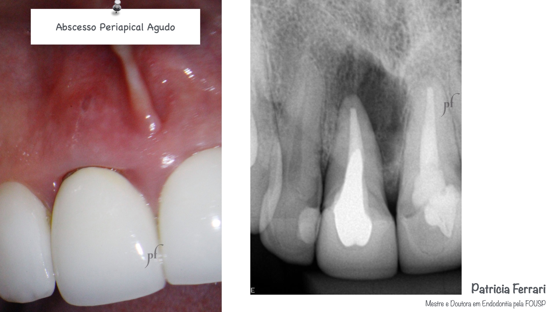 Fratura Radicular em dente com pino metálico robusto Patricia Ferrari Endodontia