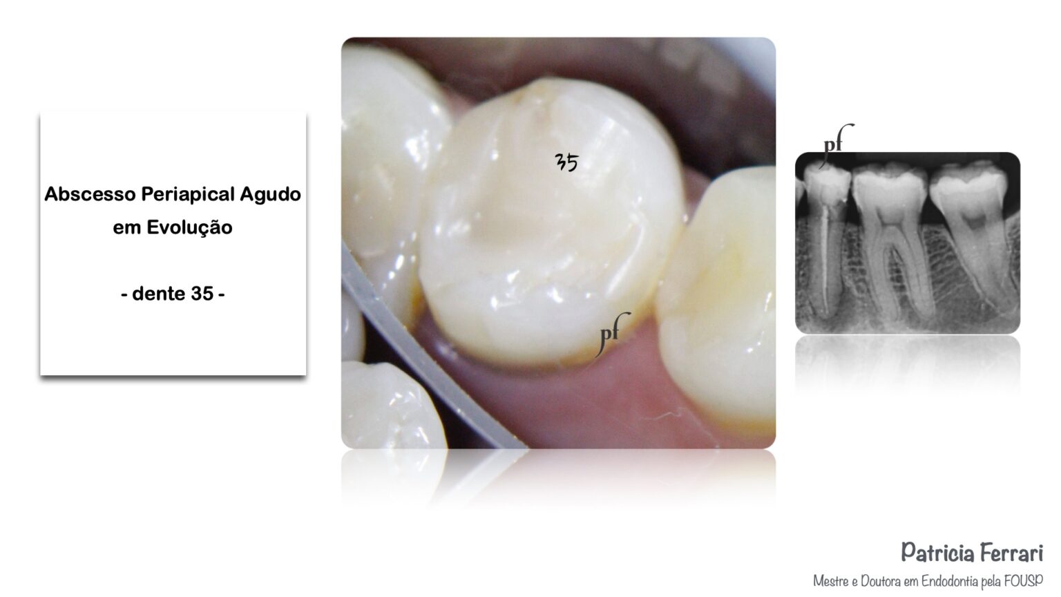 Retratamento Endod Ntico Em Dente Portador De Abscesso Periapical Agudo Patricia Ferrari