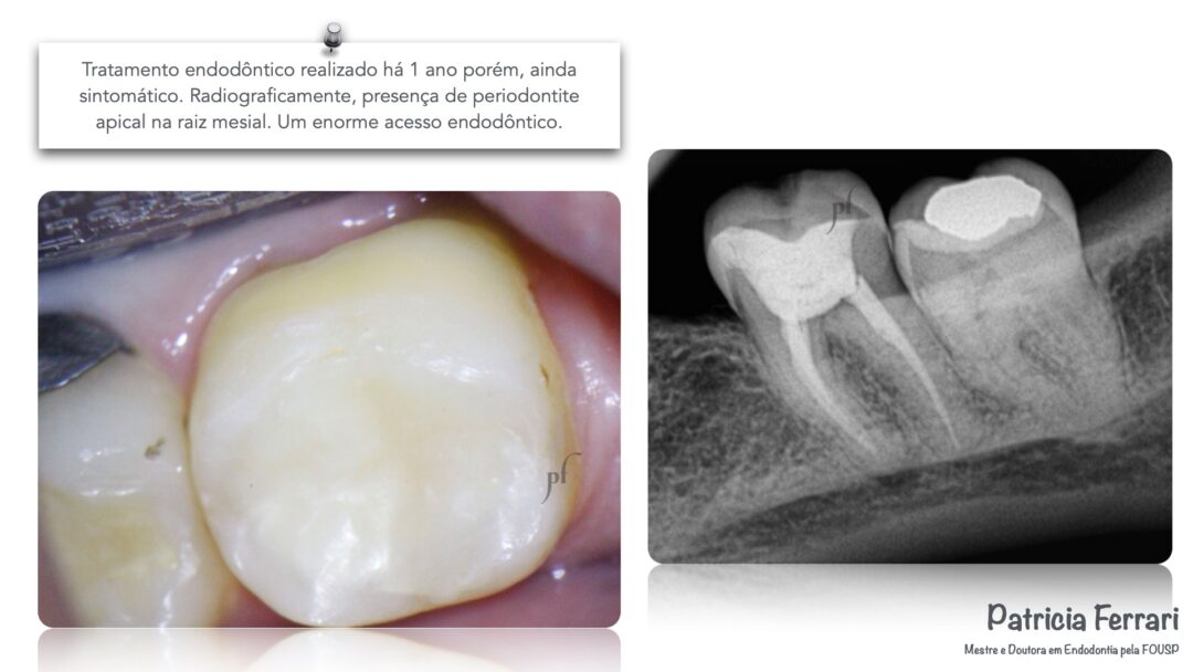 Retratamento Em Molar Inferior Sintom Tico Patricia Ferrari Endodontia