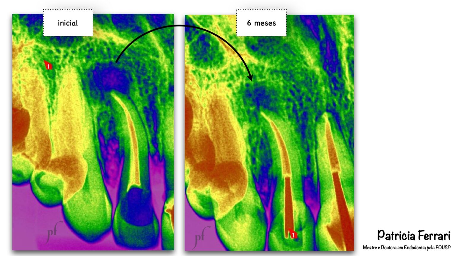 Retratamento Endod Ntico De Incisivo Lateral Superior Patricia Ferrari Endodontia