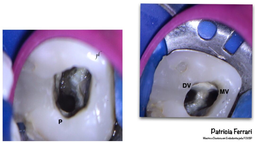 Retratamento Endodôntico de molar superior Patricia Ferrari Endodontia