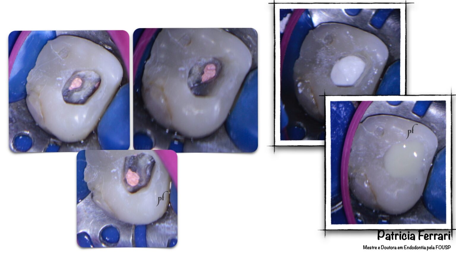 Retratamento Endod Ntico De Molar Superior Patricia Ferrari Endodontia