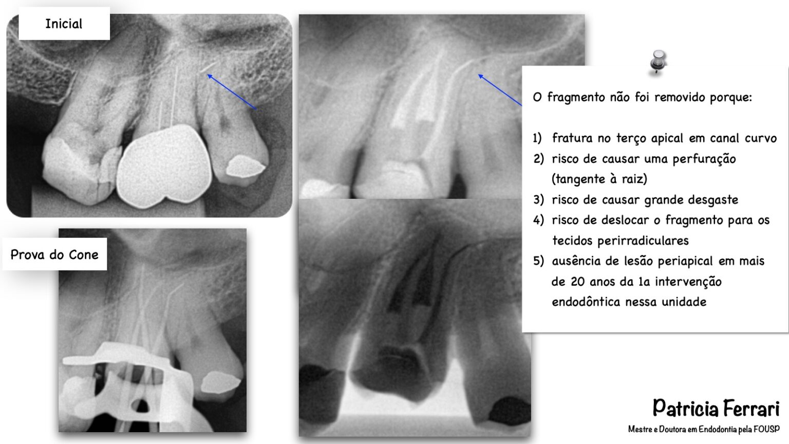 Remoção de PFV e instrumento fraturado Patricia Ferrari Endodontia