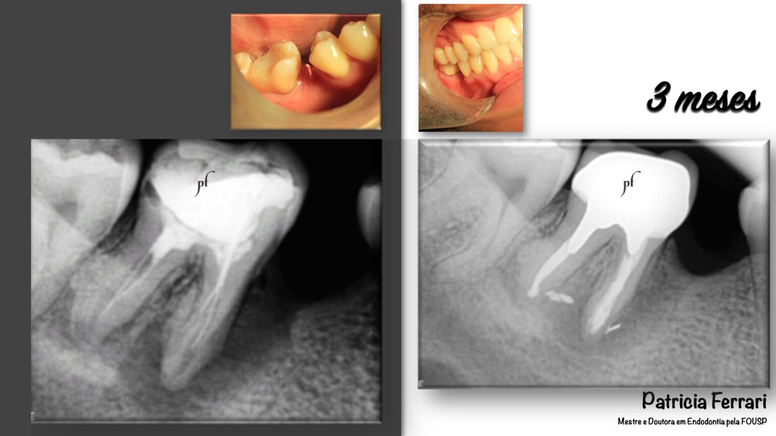 Retratamento Endodôntico em molar com grande perda óssea Patricia Ferrari Endodontia