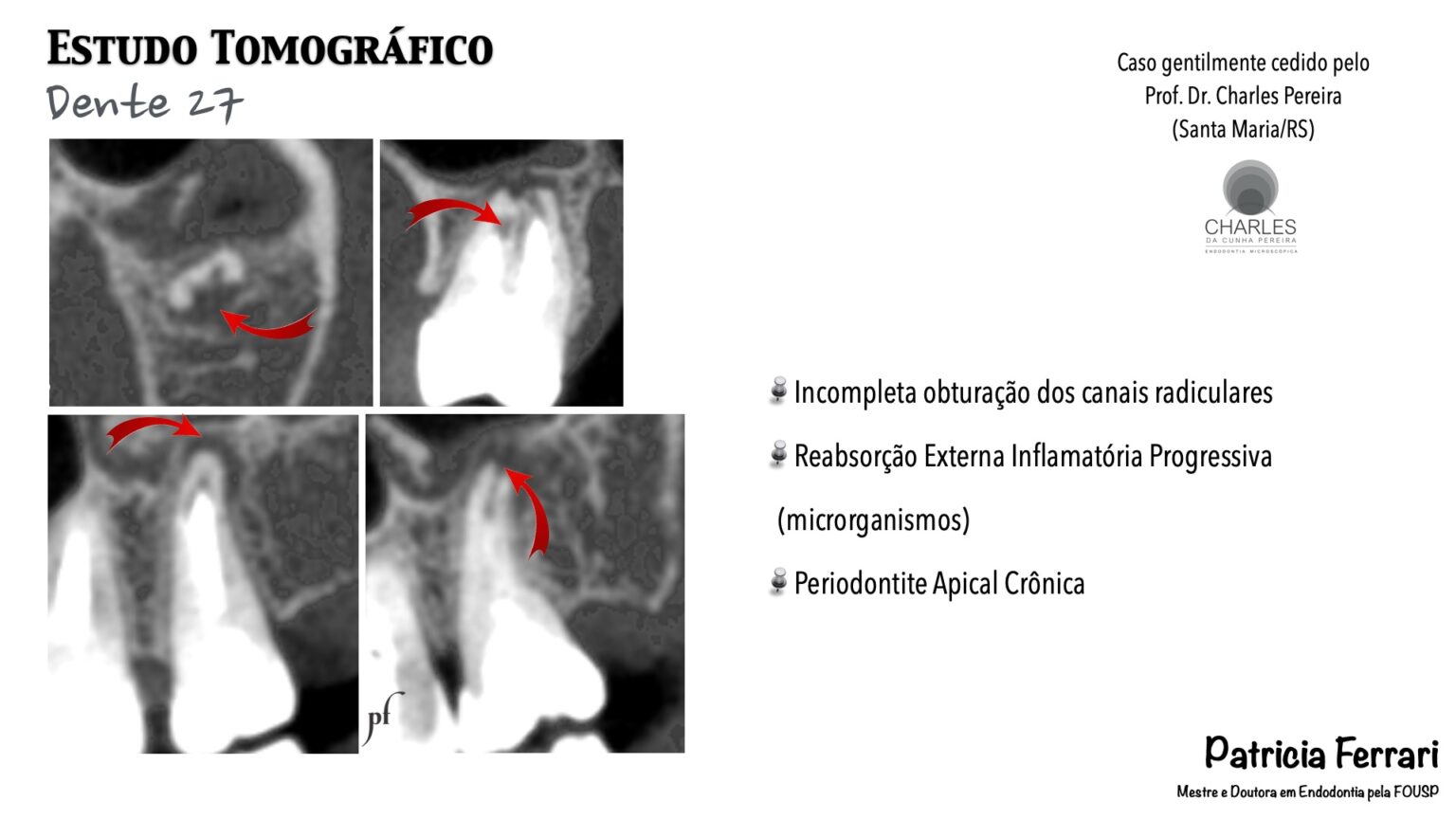 Retratamento Endod Ntico Complexo By Prof Charles Pereira Santa Maria Rs Patricia Ferrari